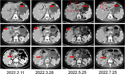 Advanced pancreatic cancer with KRAS wild-type and EGFR-sensitive mutation respond favorably to furmonertinib: A case report